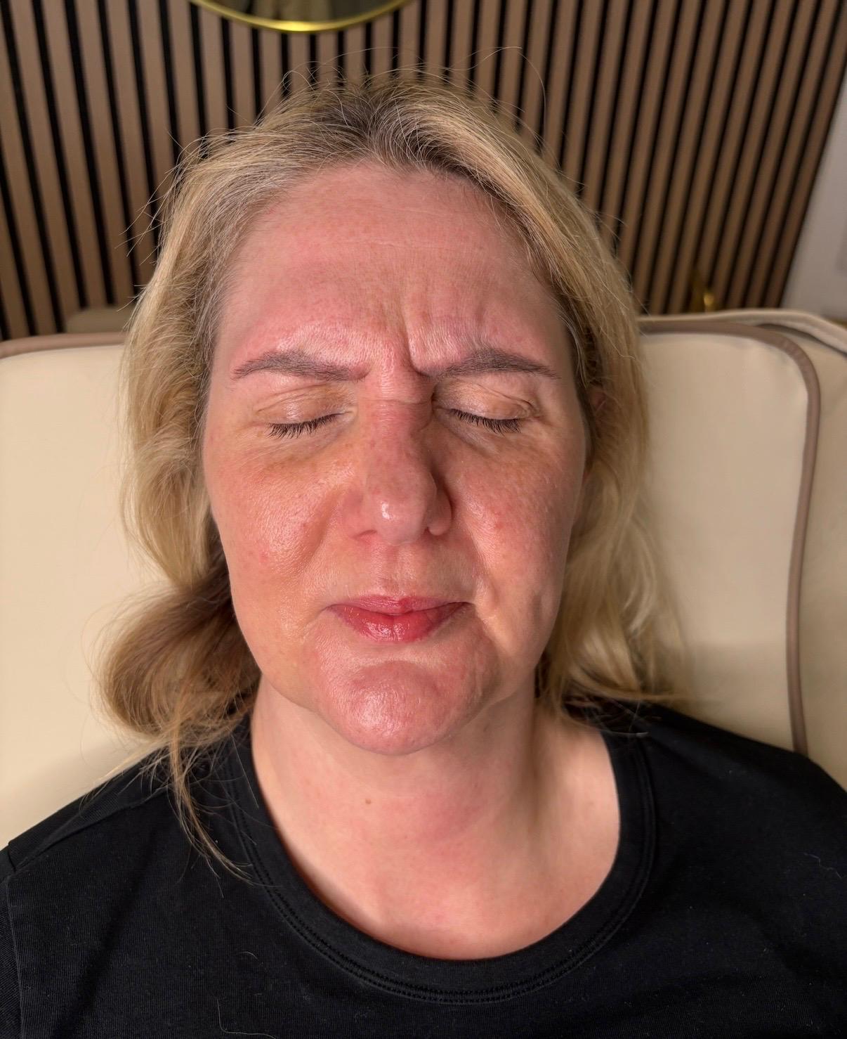 Before treatment